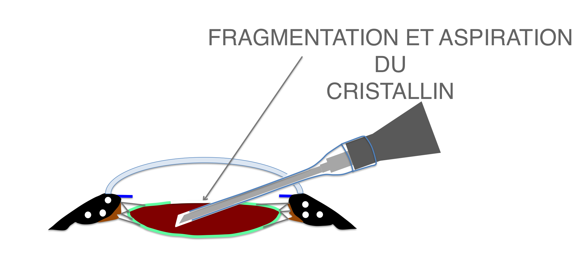 fragmentation par ultrasons et aspiration débutantes du cristallin (phakoémulsification) lors de la chirurgie de cataracte