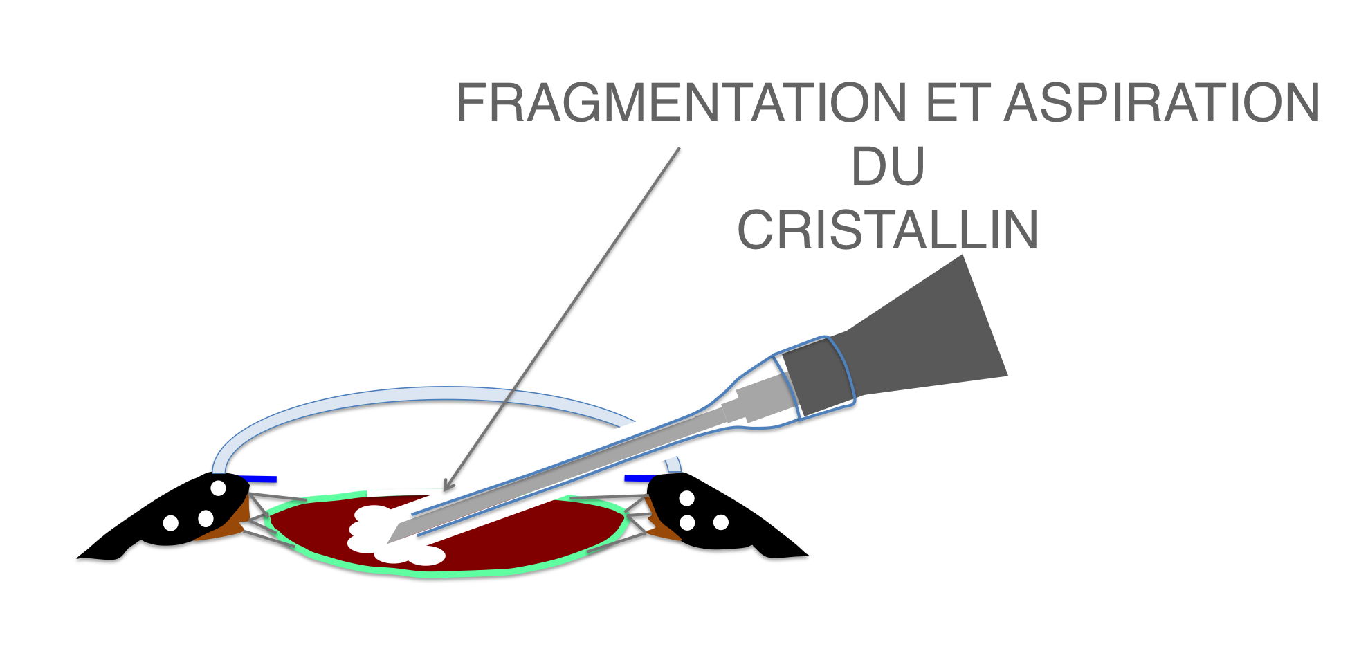 fragmentation par ultrasons et aspiration en cours du cristallin (phakoémulsification) lors de la chirurgie de cataracte