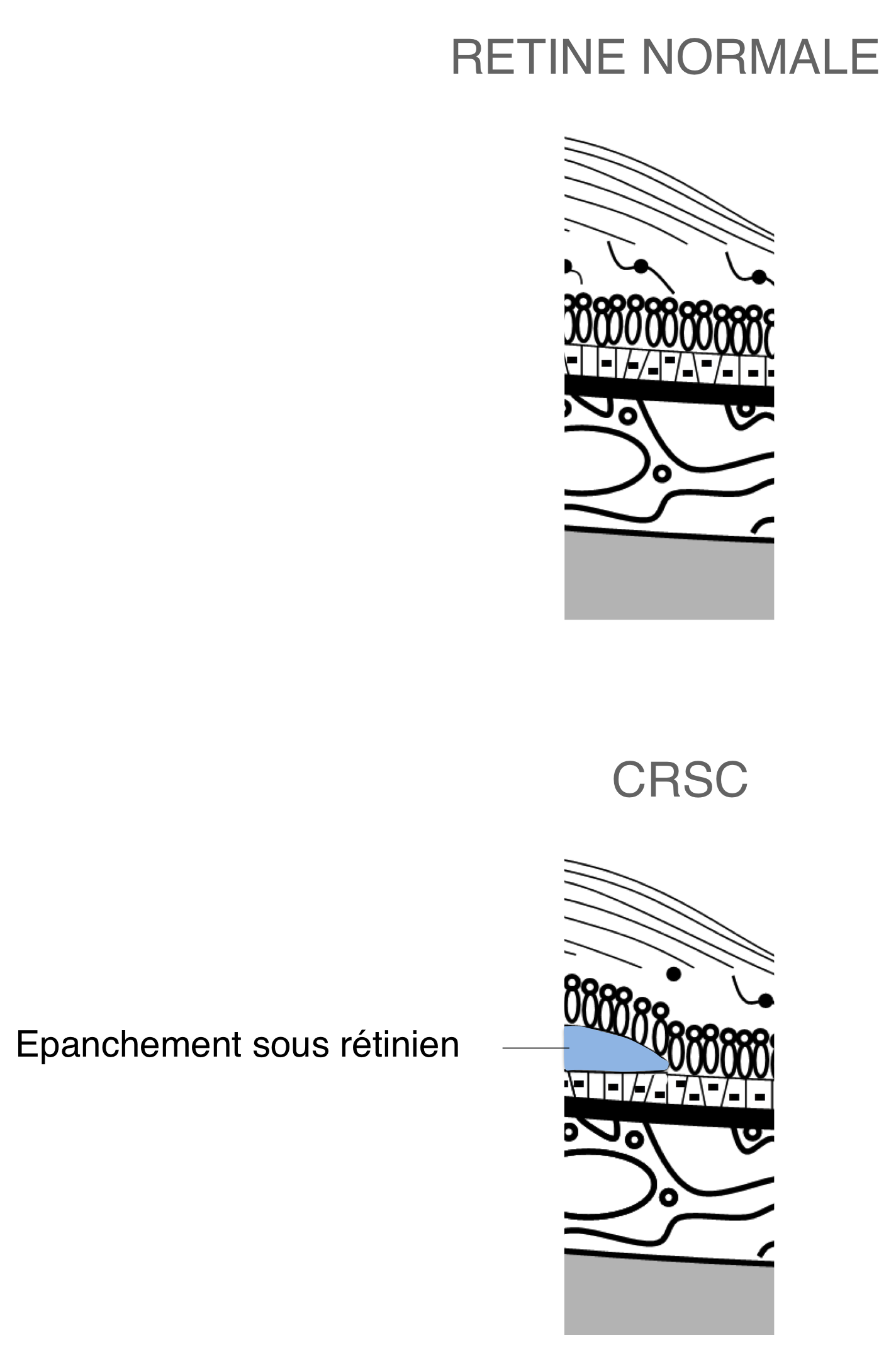 présence d'une lame de liquide sous rétinien en rapport avec la présence d'une CRSC