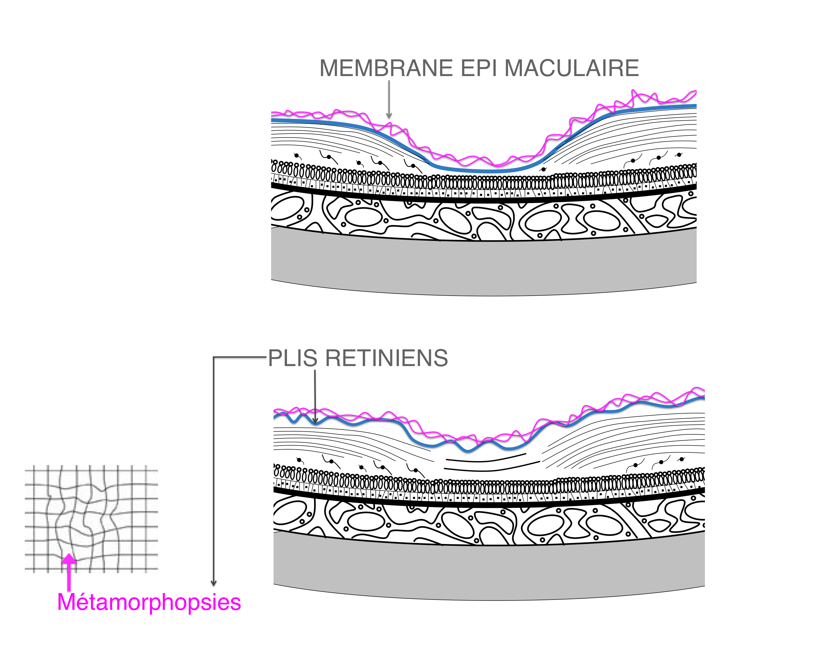 membrane épirétinienne : plis rétiniens à l'origine de déformations des lignes droites qui apparaissent ondulées (métamorphopsies)