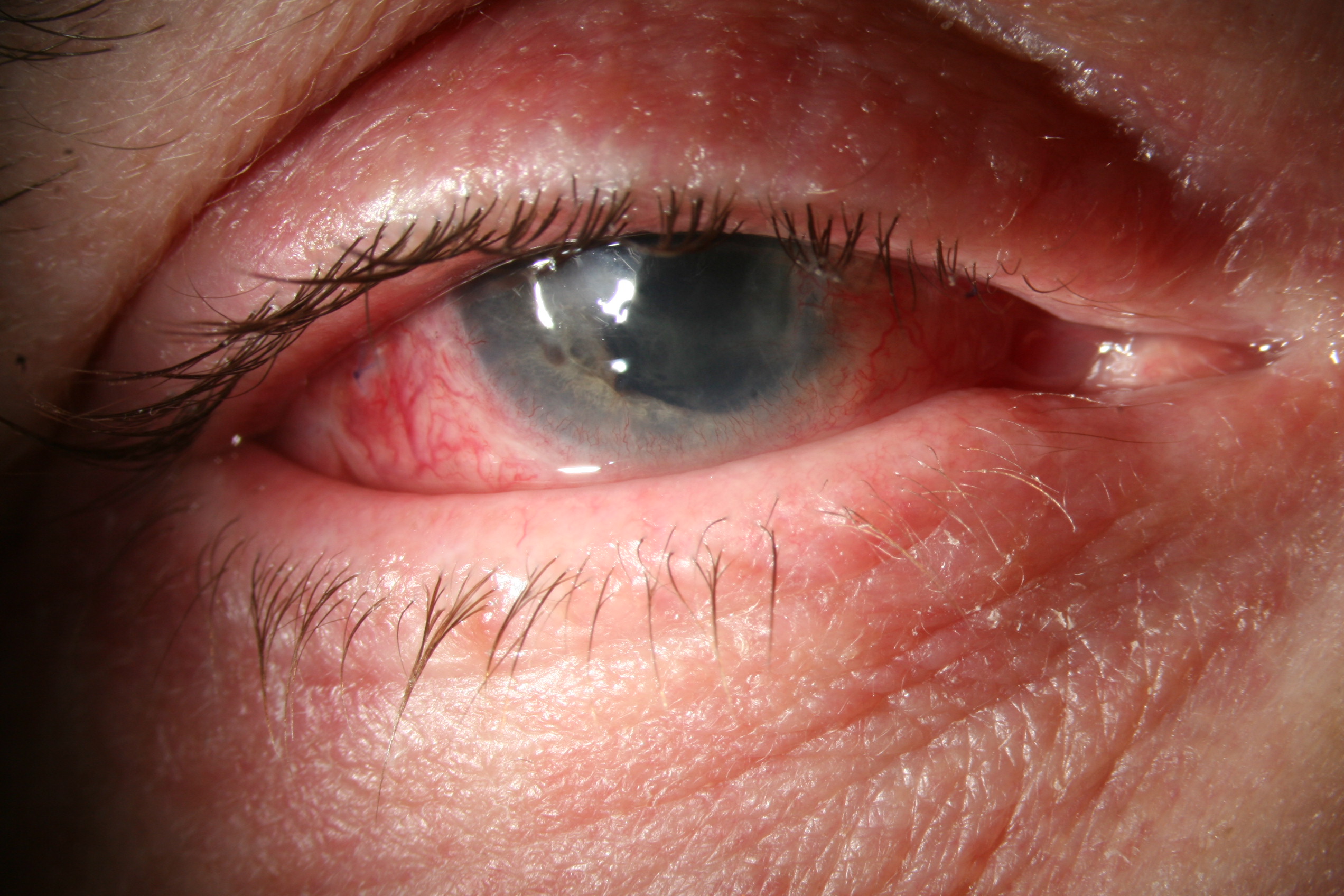 Allergies oculaires: Conjonctivite et réaction allergique